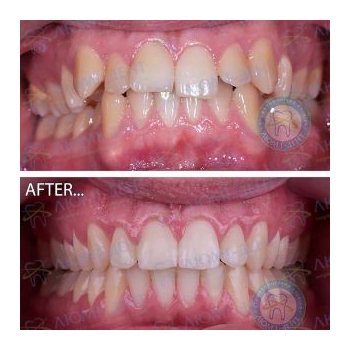 До и после исправления прикуса брекетами Брекеты фото до и после Киев Люми-Дент