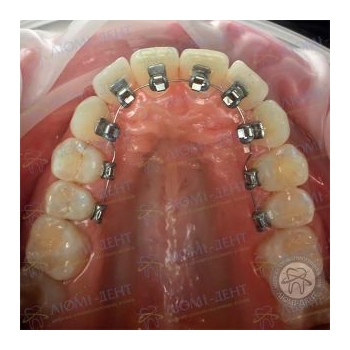 Лингвальные брекеты Лингвальные брекеты фото до после Киекв Люми-Дент
