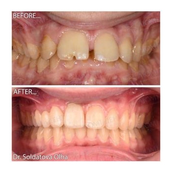 Клинический случай 5 Брекеты фото до после Люми-Дент