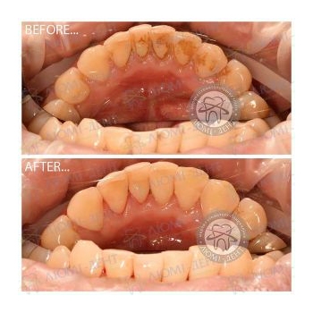 Результат профессиональной чистки зубов в нашей клинике чистка зубов ультразвуком, фото, до и после