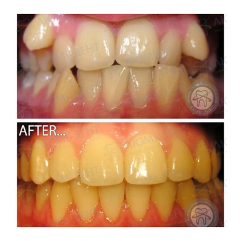 Клинический случай 16 Исправление прикуса фото Люми-Дент