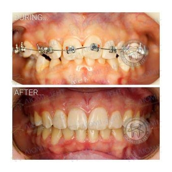 Металлические брекеты Брекет система фото до и после Киев Люми-Дент