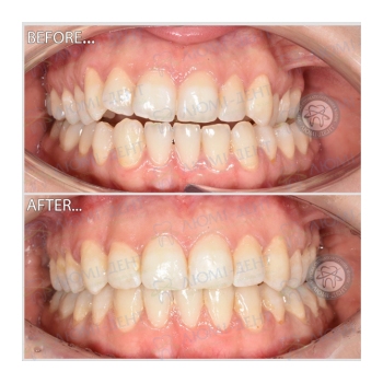 Клинический случай 11 Исправление прикуса зубов фото Люми-Дент