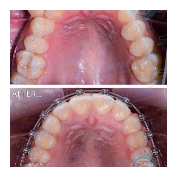 До и после исправление прикуса брекет системой Исправление прикуса зубов фото Люми-Дент