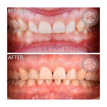 Клинический случай 14 До и после исправления прикуса фото Люми-Дент