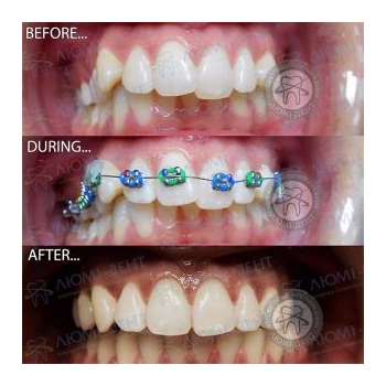 Металлические брекеты Брекеты фото до и после Киев Люми-Дент