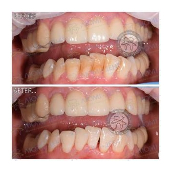 Результат профессиональной чистки зубов в нашей клинике чистка зубов киев