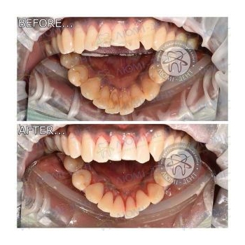 Результат профессиональной чистки зубов в нашей клинике чистка зубов киев