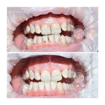 Результат профессиональной чистки зубов в нашей клинике чистка зубов киев