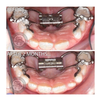 Клинический случай 10 Исправление прикуса Киев фото