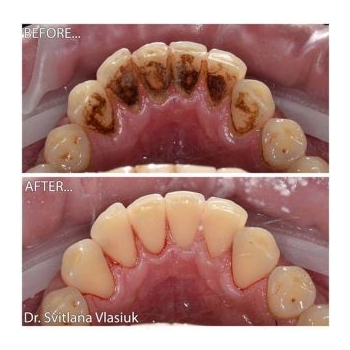 Клинический случай 3 чистка зубов киев