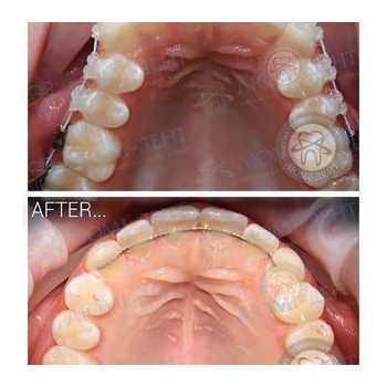 До и после исправления прикуса в Люми-Дент Брекет системы фото до и после Люми-Дент