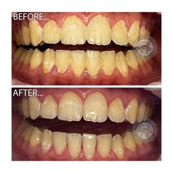 Клинический случай 5 чистка зубов ультразвуком, фото, до и после