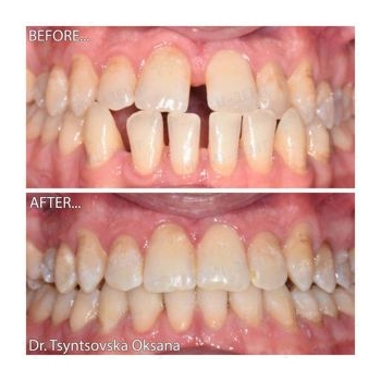 Фото до и после выравнивания зубов Исправление прикуса фото до после Люми-Дент
