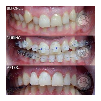 Комбинированные брекеты Комбинированные брекеты фото до и после Киев Люми-Дент