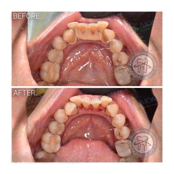 Результат профессиональной чистки зубов в нашей клинике чистка зубов киев