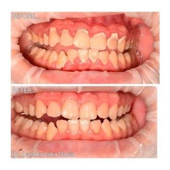 Клинический случай 2 чистка зубов киев