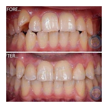 Исправление прикуса Киев фото Исправление прикуса Киев фото