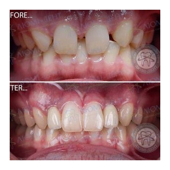 Исправление неправильного прикуса зубов Исправление прикуса брекетами  фото Люми-Дент