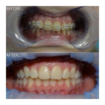 До и после выравнивания зубов брекет системой До и после исправления прикуса фото Люми-Дент