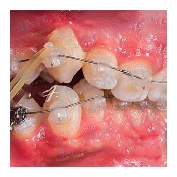 Брекет-система на зубах Брекеты фото Киев Люми-Дент