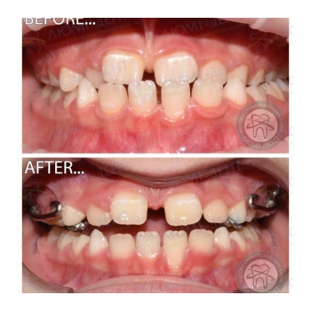 Клинический случай 12 Прикус зубов фото Люми-Дент