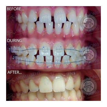 Керамические брекеты Керамические брекеты фото до и после Киев Люми-Дент