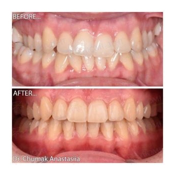 Фото до и после выравнивания зубов Исправление прикуса фото до после Люми-Дент