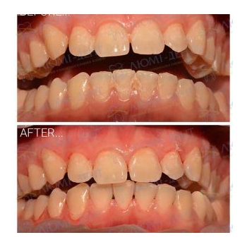 Результат профессиональной чистки зубов в нашей клинике чистка зубов киев