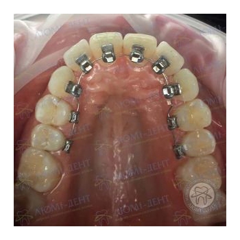 Установка лингвальной брекет системы фото Киев  Установка лингвальной брекет системы