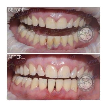 Результат профессиональной чистки зубов в нашей клинике чистка зубов киев