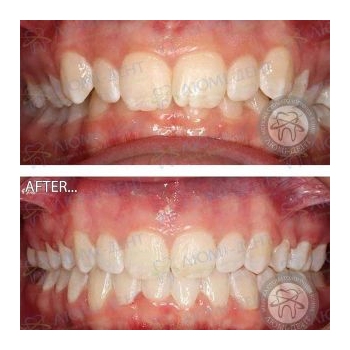 Исправление неправильного прикуса зубов Киев Исправление неправильного прикуса брекет системой Damon Clear