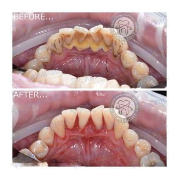 Результат профессиональной чистки зубов в нашей клинике чистка зубов киев