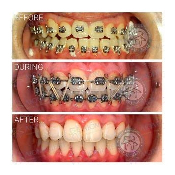 Металлическая лигатурная брекет-система Брекеты фото до и после Киев Люми-Дент