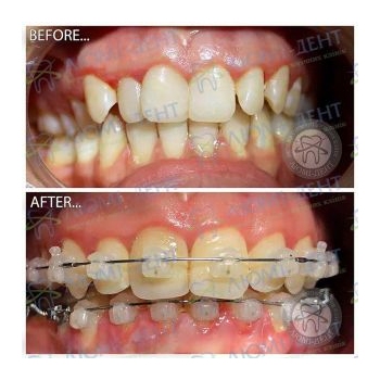 До и после выравнивания зубов брекетами Прикус зубов фото Люми-Дент