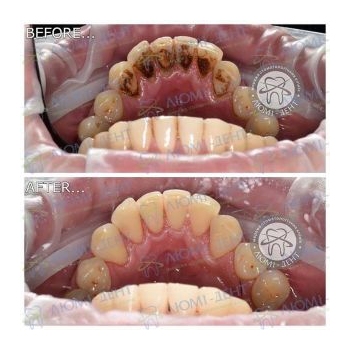 Результат профессиональной чистки зубов в нашей клинике чистка зубов киев