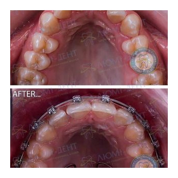 До и после лечения самолигирующей брекет-системой Брекеты фото картинки Люми-Дент
