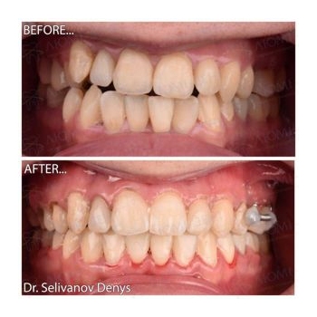 Фото до и после выравнивания зубов Исправление прикуса фото до после Люми-Дент