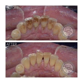 Результат профессиональной чистки зубов в нашей клинике чистка зубов киев