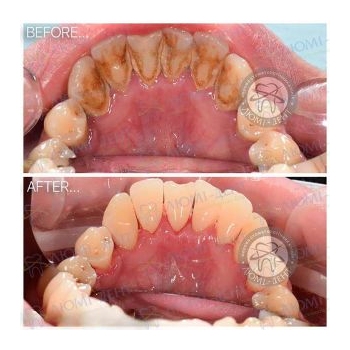 Результат профессиональной чистки зубов в нашей клинике чистка зубов ультразвуком, фото, до и после