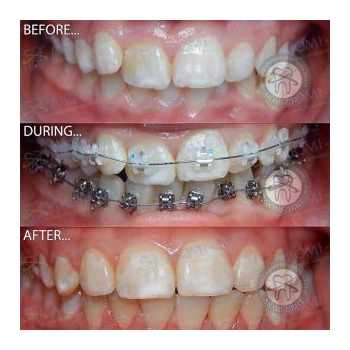 Комбинированные брекеты Брекеты фото до после Киев Люми-Дент