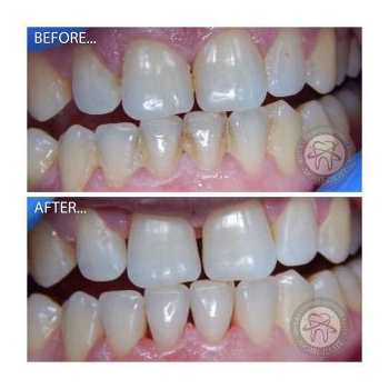 Результат профессиональной чистки зубов в нашей клинике чистка зубов