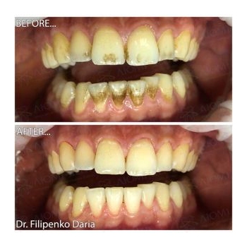 Клинический случай 4 чистка зубов