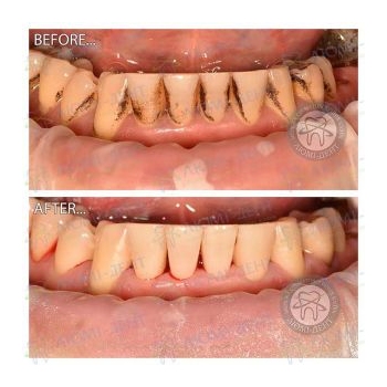 Результат профессиональной чистки зубов в нашей клинике чистка зубов ультразвуком, фото, до и после