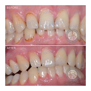 Результат профессиональной чистки зубов в нашей клинике чистка зубов киев