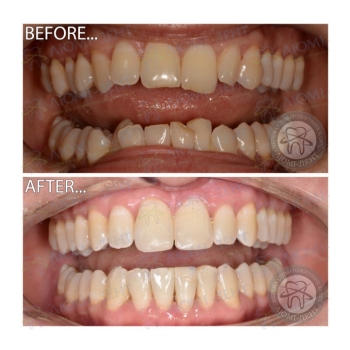 Клинический случай 9 Исправление прикуса брекетами фото Люми-Дент