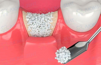 Cинус лифтинг имплантация Киев стоматология фото ЛюмиДент Cинус лифтинг имплантация Киев стоматология фото ЛюмиДент