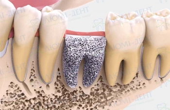 Костная имплантация зубов фото Киев Люми-Дент Костная имплантация зубов фото Киев Люми-Дент