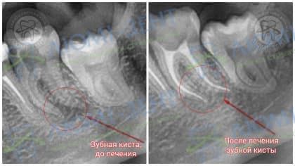 Фото киста на верхней десне