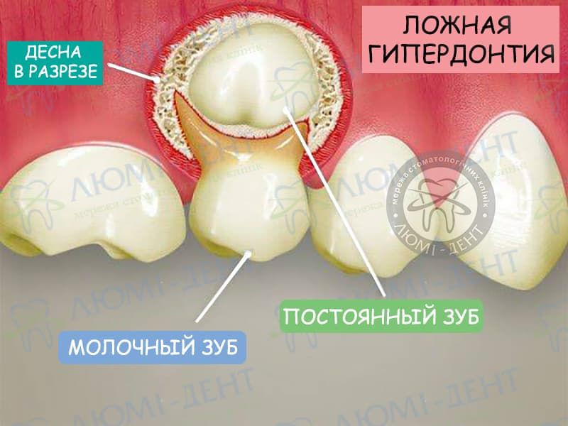 Частый стул из за прорезывания зубов